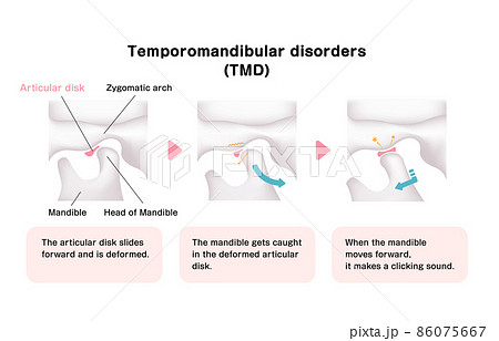 顎関節症の発生の仕組みと原因 ベクターイラスト (英語) 顎関節症の発生の仕組みと原因 ベクターイラスト (英語) 86075667