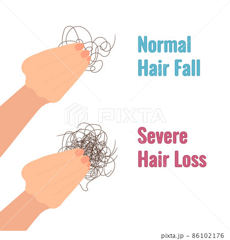 Hair shedding versus hair loss medical diagram Hair shedding versus hair loss medical diagram 86102176