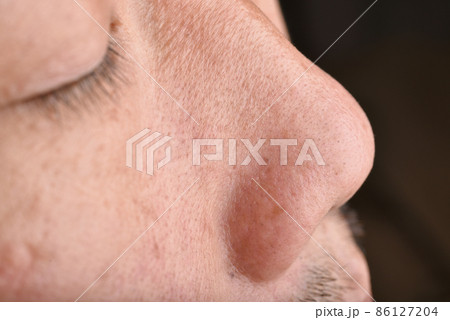 Skin problem with wrinkle and pigmentation, Close up men face with acne and dry skin Skin problem with wrinkle and pigmentation, Close up men face with acne and dry skin 86127204