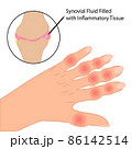 Rheumatoid arthritis on fingers medical vector illustration 86142514