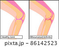 Healthy knee joint and Rheumatoid arthritis medical vector illustration 86142523