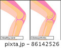 Healthy knee joint and osteoarthritis vector illustration 86142526