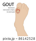 Gout arthritis. Human foot. Vector medical illustration. 86142528