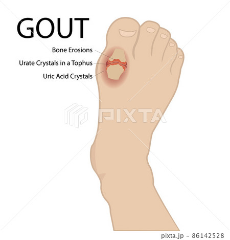 Gout arthritis. Human foot. Vector medical illustration. 86142528
