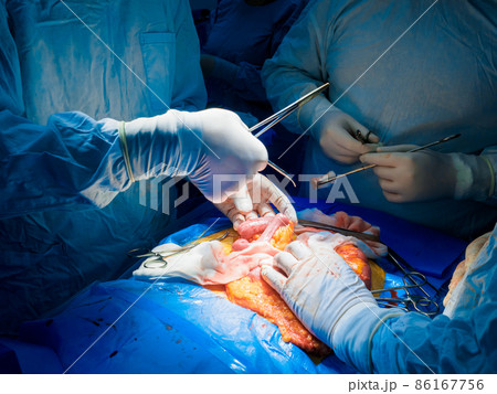 Hands of surgeons during surgery on the abdominal cavity of a person. 86167756