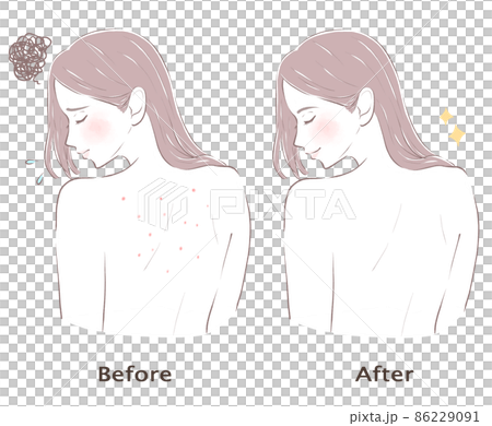 荒れた背中が治った女性 86229091