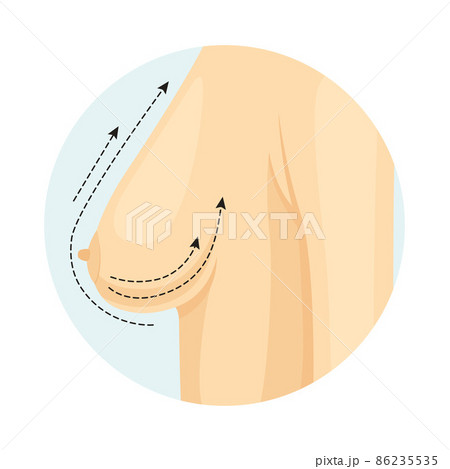 Cosmetic surgery on breast with dotted lines. Breast lift. Plastic surgery vector illustration Cosmetic surgery on breast with dotted lines. Breast lift. Plastic surgery vector illustration 86235535