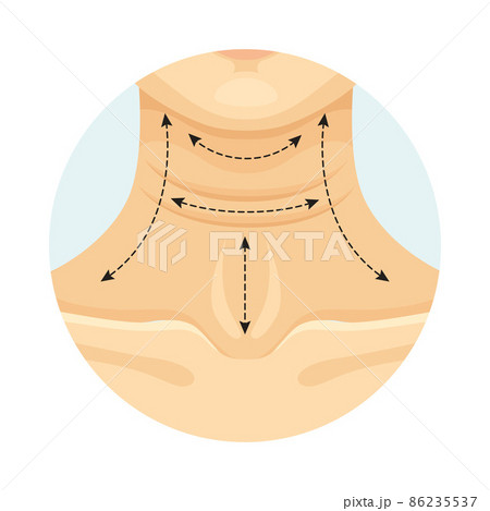 Cosmetic surgery on female neck with dotted lines. Platysmoplasty. Plastic surgery vector illustration 86235537