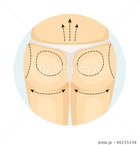 Cosmetic surgery on female body with dotted lines. Buttocks correction procedure. Plastic surgery vector illustration Cosmetic surgery on female body with dotted lines. Buttocks correction procedure. Plastic surgery vector illustration 86235538