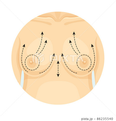 Cosmetic surgery on breast with dotted lines. Front view of female body. Plastic surgery vector illustration 86235540