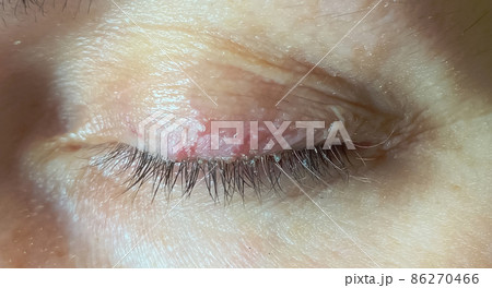 Close-up photography, selective focus, dermatological infection of the skin, demodicosis of the eyelid Close-up photography, selective focus, dermatological infection of the skin, demodicosis of the eyelid 86270466