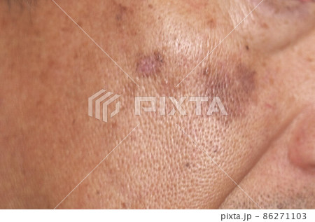 初老男性の頬に出来た大きなシミ2 86271103