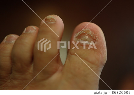 歩きすぎで剥がれた爪の再生の写真素材