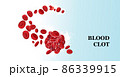 Blood clot thrombus medical poster 86339915