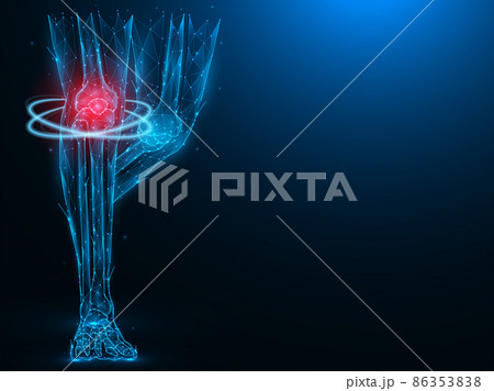 Polygonal vector illustration of human legs, painful and inflamed knee. Sick knee recovery concept. Treatment of arthritis of the knee joints. Futuristic medical banner, template or background. 86353838