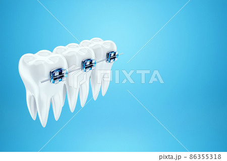 White teeth with metal braces on a blue background. Dental braces, orthodontic treatment, dentistry, teeth whitening, protection, oral care, hygiene, healthcare. 3D illustration, 3D render. 86355318