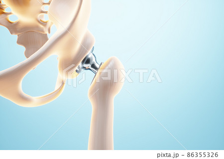 Medical poster image of a hip implant. artificial joint, Arthritis, inflammation, fracture, cartilage. 3D illustration, 3D render. Medical poster image of a hip implant. artificial joint, Arthritis, inflammation, fracture, cartilage. 3D illustration, 3D render. 86355326