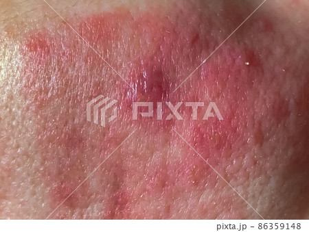 Close-up, selective focus, dermatological infection of the skin, in which redness and rashes on the skin of the face 86359148