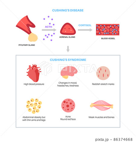 Cushing Desease poster Cushing Desease poster 86374668