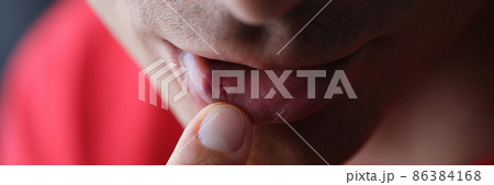 On male lip herpes from inside closeup 86384168