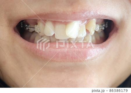 矯正中の歯 86386179