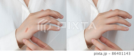 Close up of woman hands before and after treatment cream to removal burn scar. Dermatology and skin problems concept. Close up of woman hands before and after treatment cream to removal burn scar. Dermatology and skin problems concept. 86401143