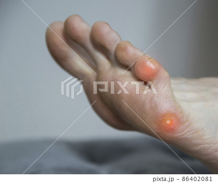 Plantar wart on the foot and little toe in humans. Treatment and removal of warts on the sole in dermatology. Copy space for text 86402081