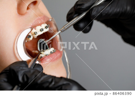 A young woman with metal braces is being examined by an orthodontist. Correction of the bite of teeth in the dental clinic. Concept of healthy teeth. A young woman with metal braces is being examined by an orthodontist. Correction of the bite of teeth in the dental clinic. Concept of healthy teeth. 86406390