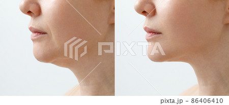 A close portrait of an aged woman before and after facial rejuvenation procedure. Correction of the chin shape liposuction of the neck. The result of the procedure in the clinic of aesthetic medicine. A close portrait of an aged woman before and after facial rejuvenation procedure. Correction of the chin shape liposuction of the neck. The result of the procedure in the clinic of aesthetic medicine. 86406410