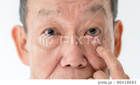 シニア男性　目　白内障　ドライアイ 86418683