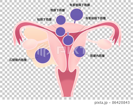 子宮筋腫のイラスト(字入り) 子宮筋腫のイラスト(字入り) 86420843