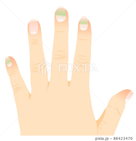 グリーンネイルになった指のイラスト素材 グリーンネイルになった指のイラスト素材