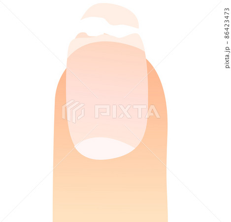 爪が折れた指 爪が折れた指 86423473