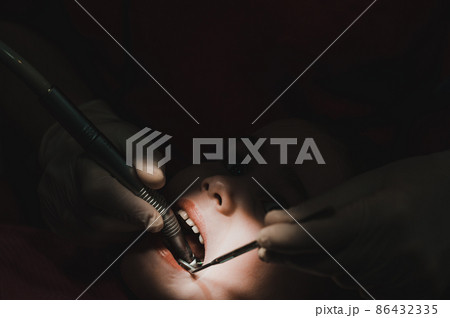 Treatment of baby teeth in a child, a little girl at the dentist, examination and treatment of teeth. Treatment of baby teeth in a child, a little girl at the dentist, examination and treatment of teeth. 86432335