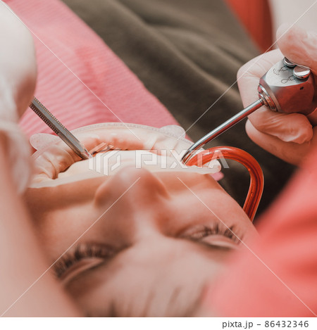 Dental treatment of a child, removal of caries with a drill, open mouth and ejector saliva. 86432346