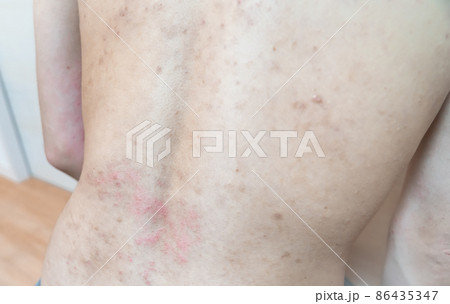 アトピー / あせも / 皮膚炎のイメージ。　肌荒れ男性の写真。 86435347