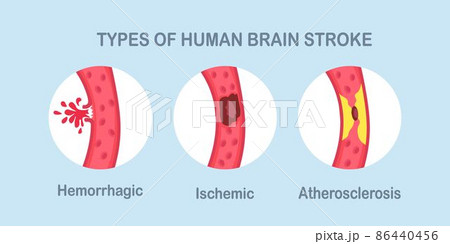 Types of human brain stroke. Ischemic, atherosclerosis and hemorrhagic stroke disease 86440456