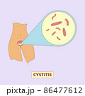 Cystitis, bacterial infection of urinary bladder illustration. Female health, disease, urology. For topics like inflammation, diarrhea, diagnosis 86477612