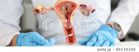 Gynecologist holds urogenital cytobrushes and model of female reproductive system 86530200