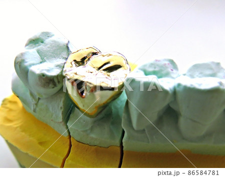 歯科 歯 ゴールド 86584781