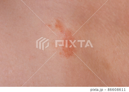 The great red spot on the skin closeup The great red spot on the skin closeup 86608611