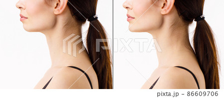 A close portrait of a young woman before and after plastic correction of the chin shape. The result of the procedure in the clinic of aesthetic medicine. A close portrait of a young woman before and after plastic correction of the chin shape. The result of the procedure in the clinic of aesthetic medicine. 86609706