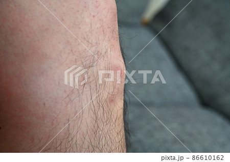 オスグッド病　オスグッド・シュラッター病　成長痛　膝　足 86610162