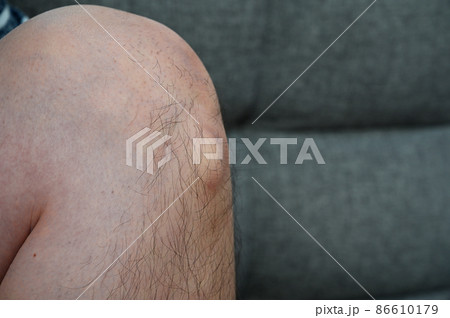 オスグッド病　オスグッド・シュラッター病 　成長痛　膝　足 86610179