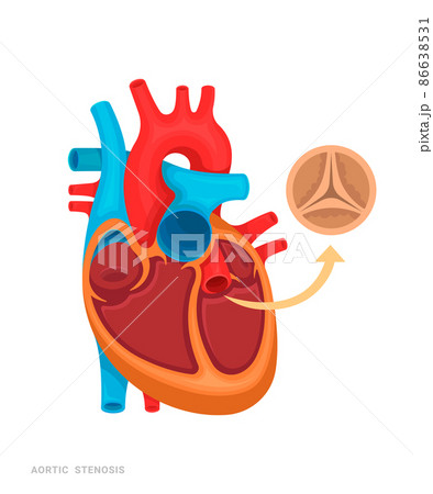 Heart defect. Aortic stenosis. Illustration for medicine books, websites, apps. Heart disease with name. Heart defect. Aortic stenosis. Illustration for medicine books, websites, apps. Heart disease with name. 86638531