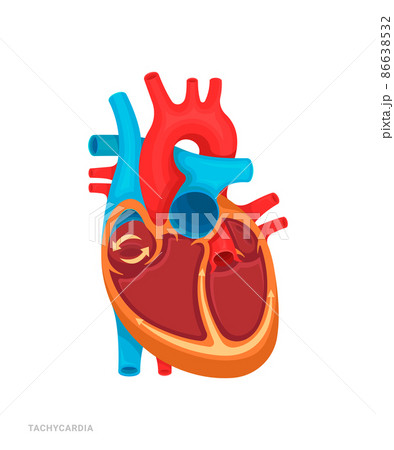Heart defect. Tachycardia. Illustration for medicine books, websites, apps. Heart disease with name. 86638532
