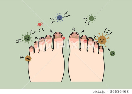 Unhealthy foot with nail infection or virus Unhealthy foot with nail infection or virus 86656468