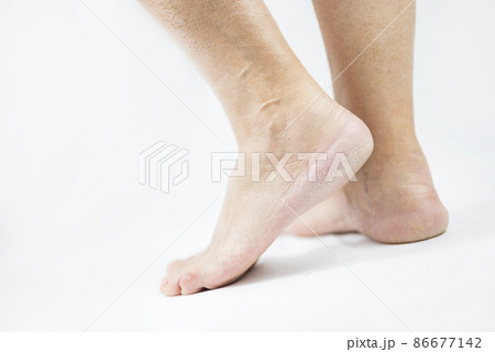 feet of an adult man aged aging with dry heels and cracked disease on a white background feet of an adult man aged aging with dry heels and cracked disease on a white background 86677142