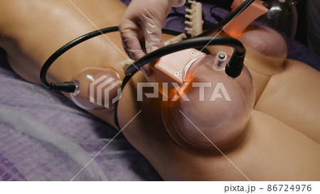 Woman Receiving Vacuum Cupping Device, Butt Skin Lifting Therapy Pump Lifting Enhancer Cup Machine Massager, Beauty Tool, Salon SPA, Hip Shaping 86724976