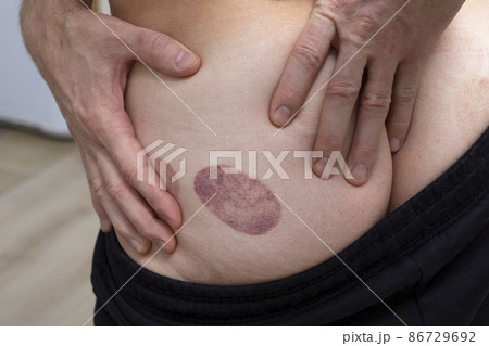 man buttock with hematomas marks after taking cupping therapy. 86729692
